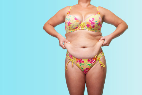 Post Bariatric Circumferential Tummy Tuck: What You Need to Know