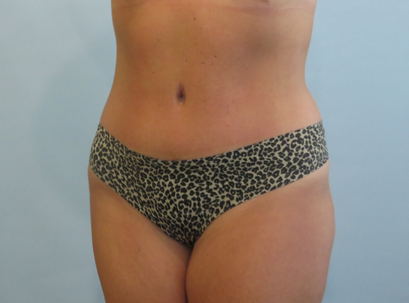 case-26-obl-l-after