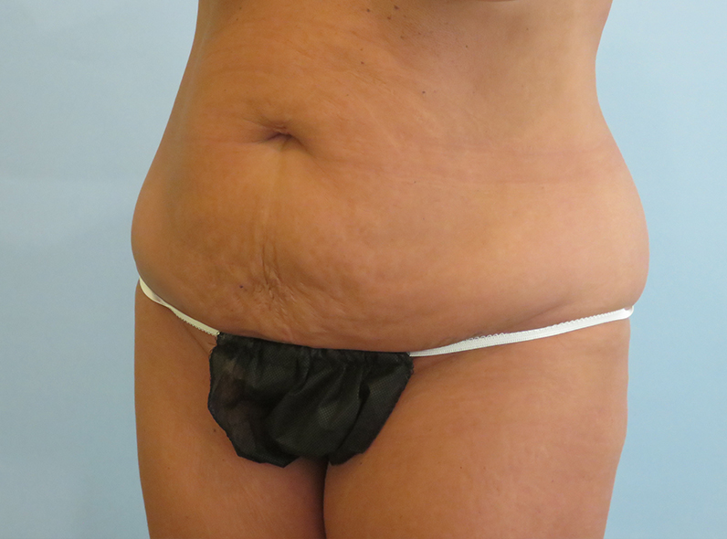 case-26-obl-l-before