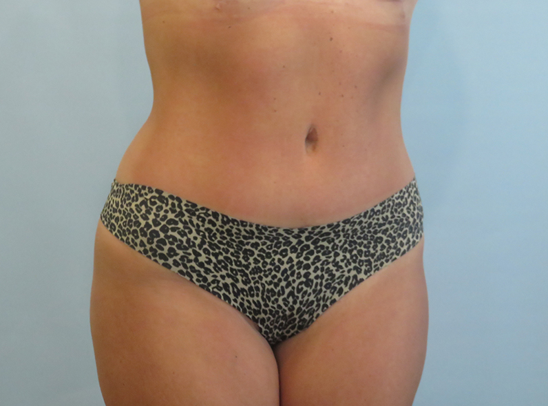 case-26-obl-r-before