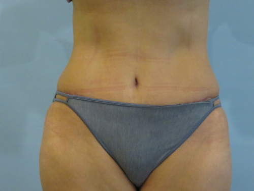 Tummy Tuck | 360 Body Lift Before and After case 2