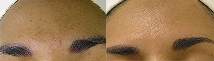 Hydrafacial Austin Before & After