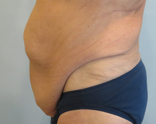 Can I Get Rid of My Male Tummy Tuck Scars