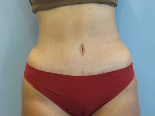 Tummy Tuck | 360 Body Lift Befor and After case 7