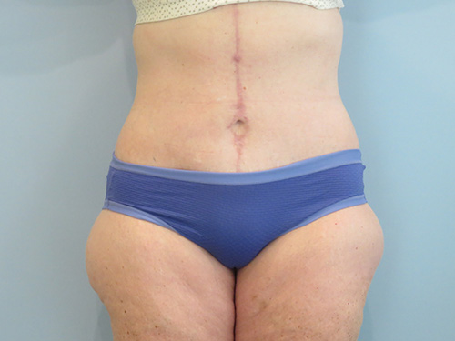 Tummy Tuck | 360 Body Lift Before & After case 10