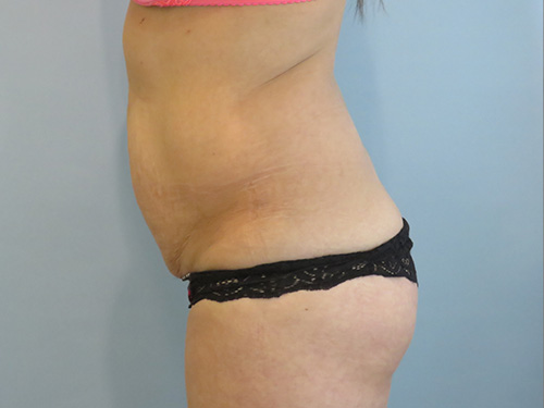 Tummy Tuck | 360 Body Lift Before & After case 6