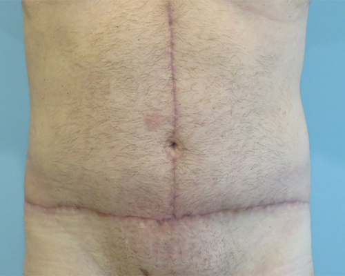 Tummy Tuck | 360 Body Lift Before and After case 4