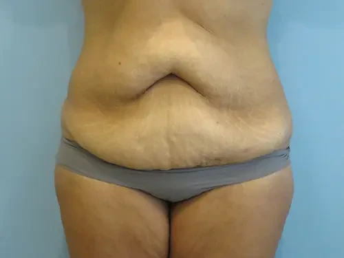 Mini Tummy Tuck Before & After