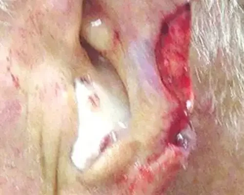 Skin Cancer Before & After