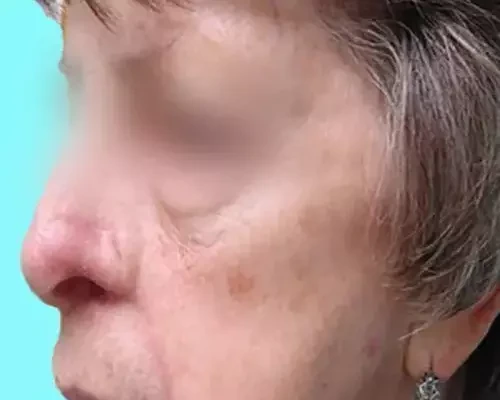 Skin Cancer Before & After