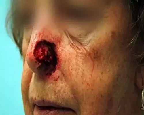 Skin Cancer Before & After