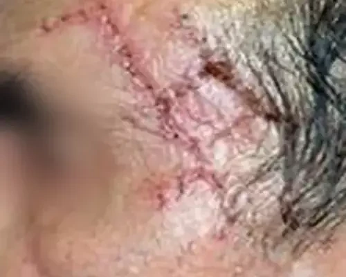 Skin Cancer Before & After