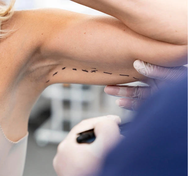 Austin, TX Body Surgery: Arm Liposuction Banner