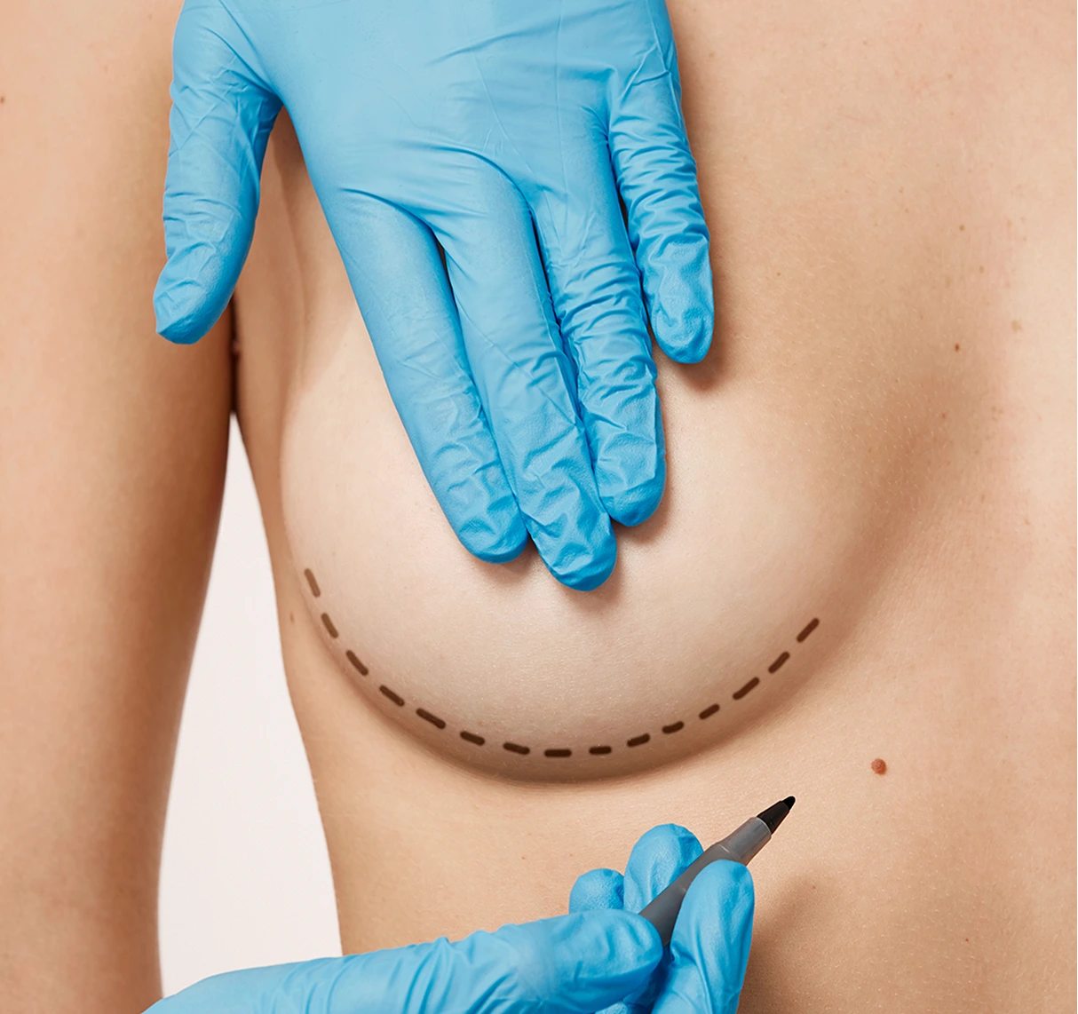 Breast Surgery Austin, TX: Breast Augmentation with Fat Transfer Banner
