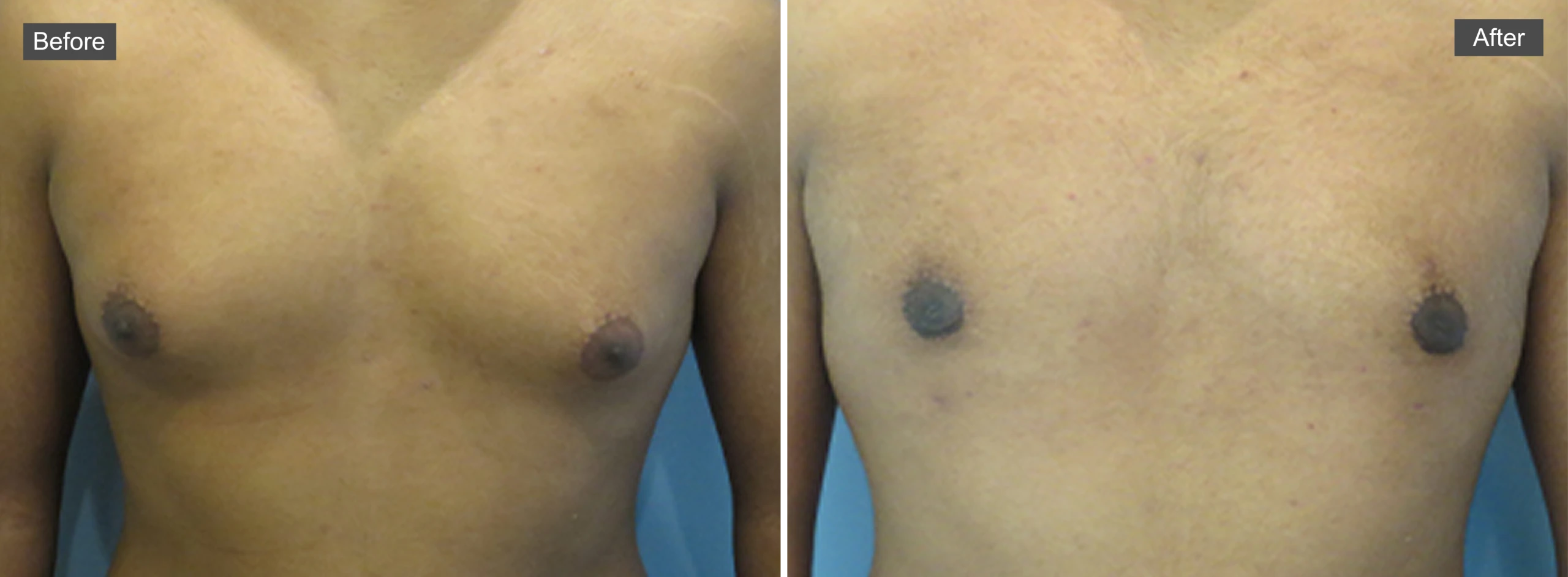 Before and after chest comparison showing reduction in gynecomastia appearance