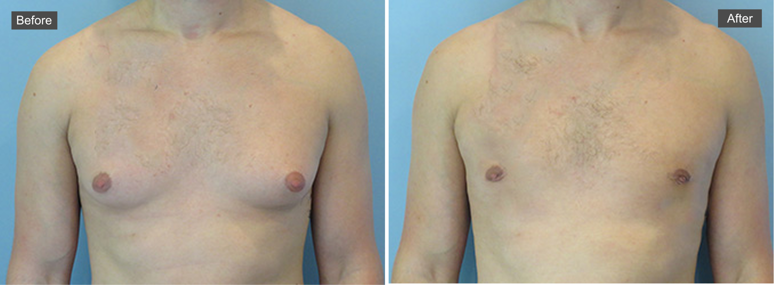 Before and after gynecomastia surgery showing reduced breast tissue and improved chest contour
