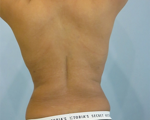 smart-liposuction-liposuction-2660.webp