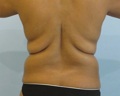 smart-liposuction-liposuction-2661.webp