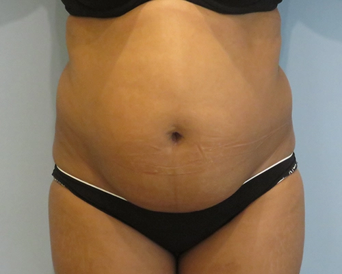 smart-liposuction-liposuction-2667.webp