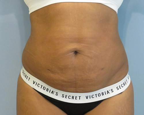 smart-liposuction-liposuction-2671.webp