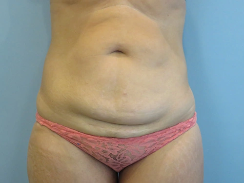 tummy-tuck-360-body-lift-4350.webp