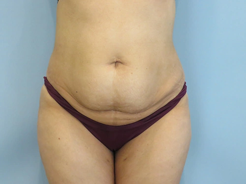 tummy-tuck-360-body-lift-4372.webp