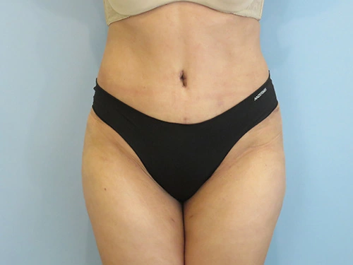 tummy-tuck-360-body-lift-4377.webp