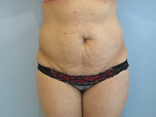 tummy-tuck-360-body-lift-4394.webp