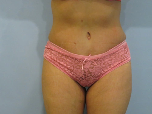 tummy-tuck-360-body-lift-4399.webp