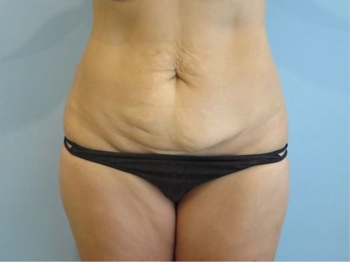 tummy-tuck-body-lift-2337.webp