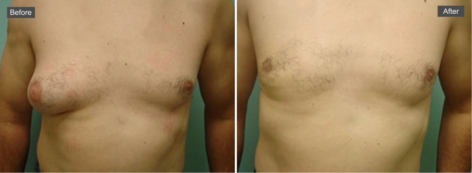 Before and after chest surgery results showing reduced tissue on right side