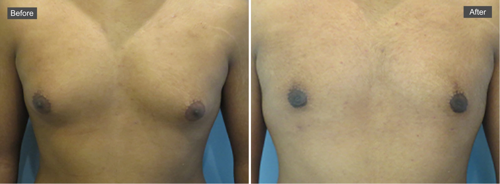 Before and after chest surgery results showing reduced tissue on right side