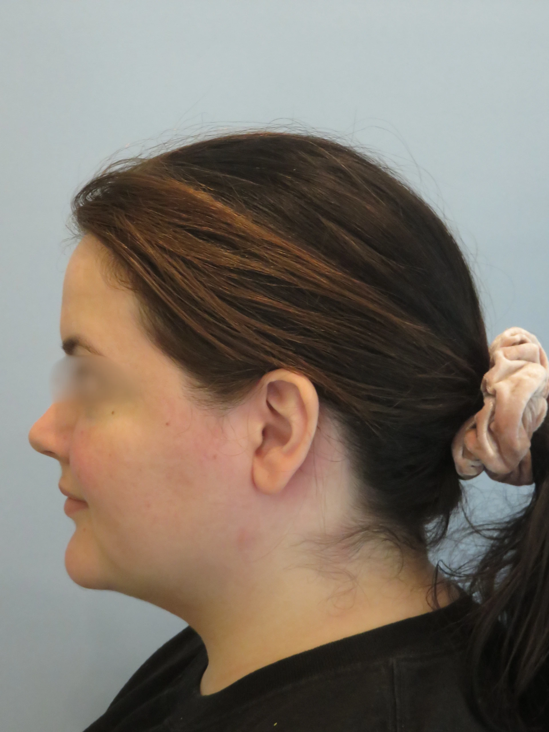 After Chin Lipo   IMG 0858.JPG (1) — Aspira Plastic Surgery & Med Spa, Austin TX