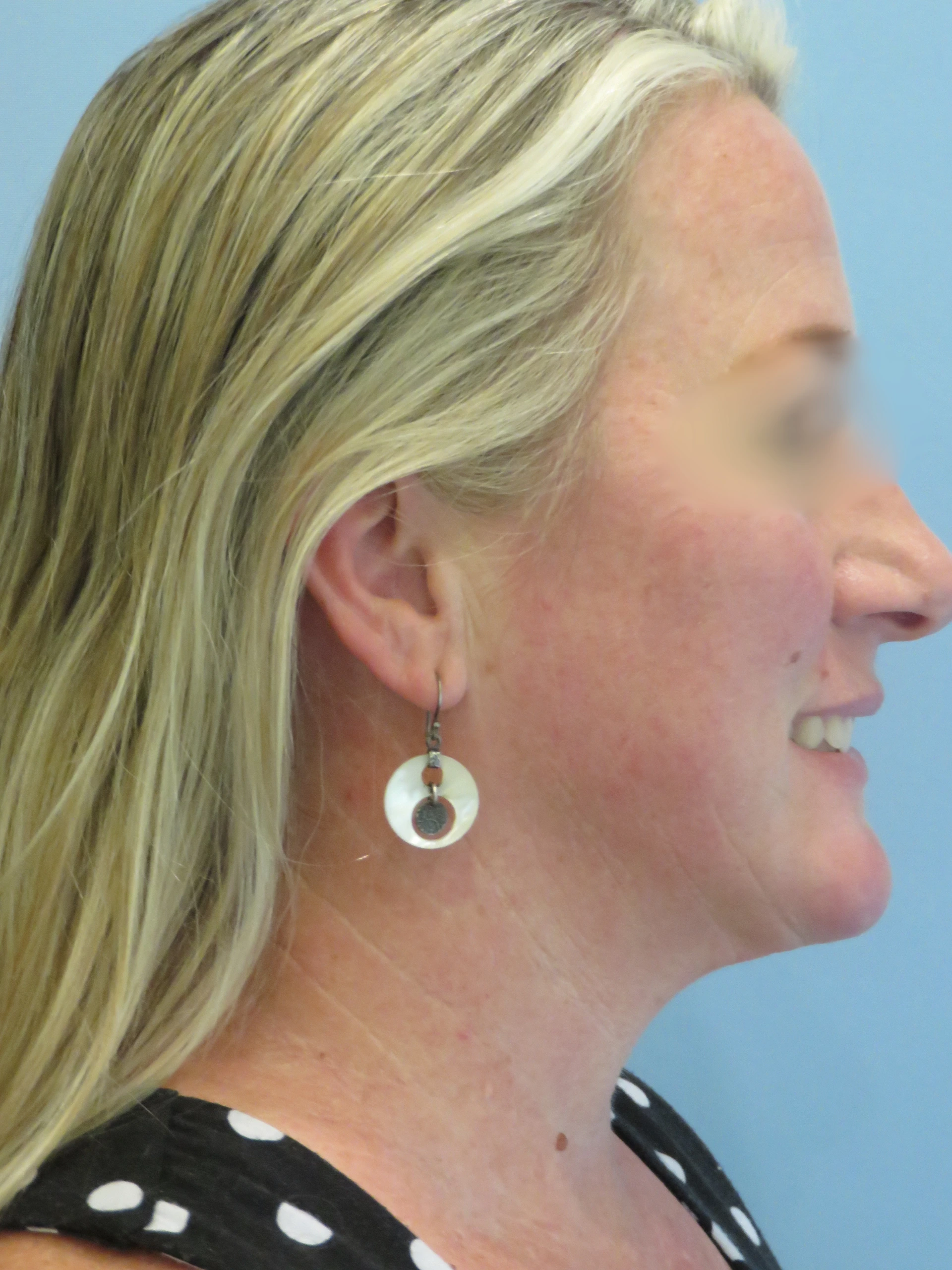 After Chin  lipo 8415.JPG (1) — Aspira Plastic Surgery & Med Spa, Austin TX