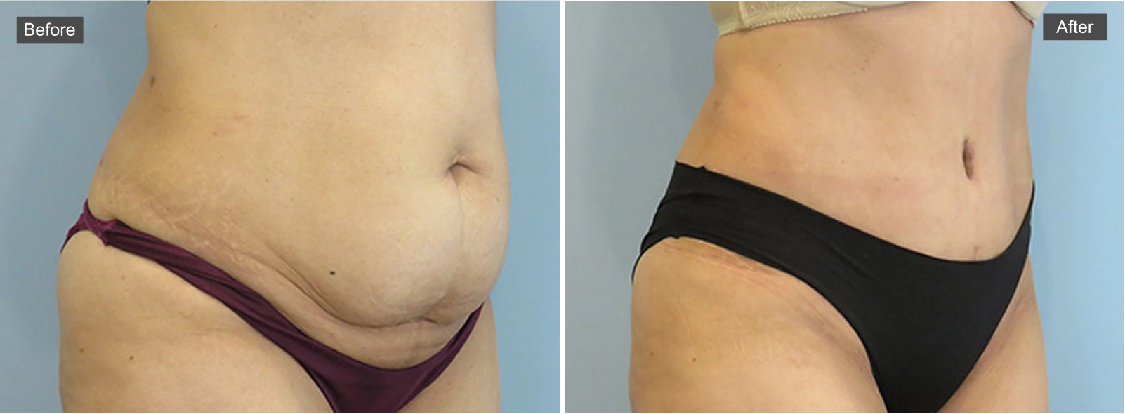 Before tummy tuck: abdomen with loose skin and fullness