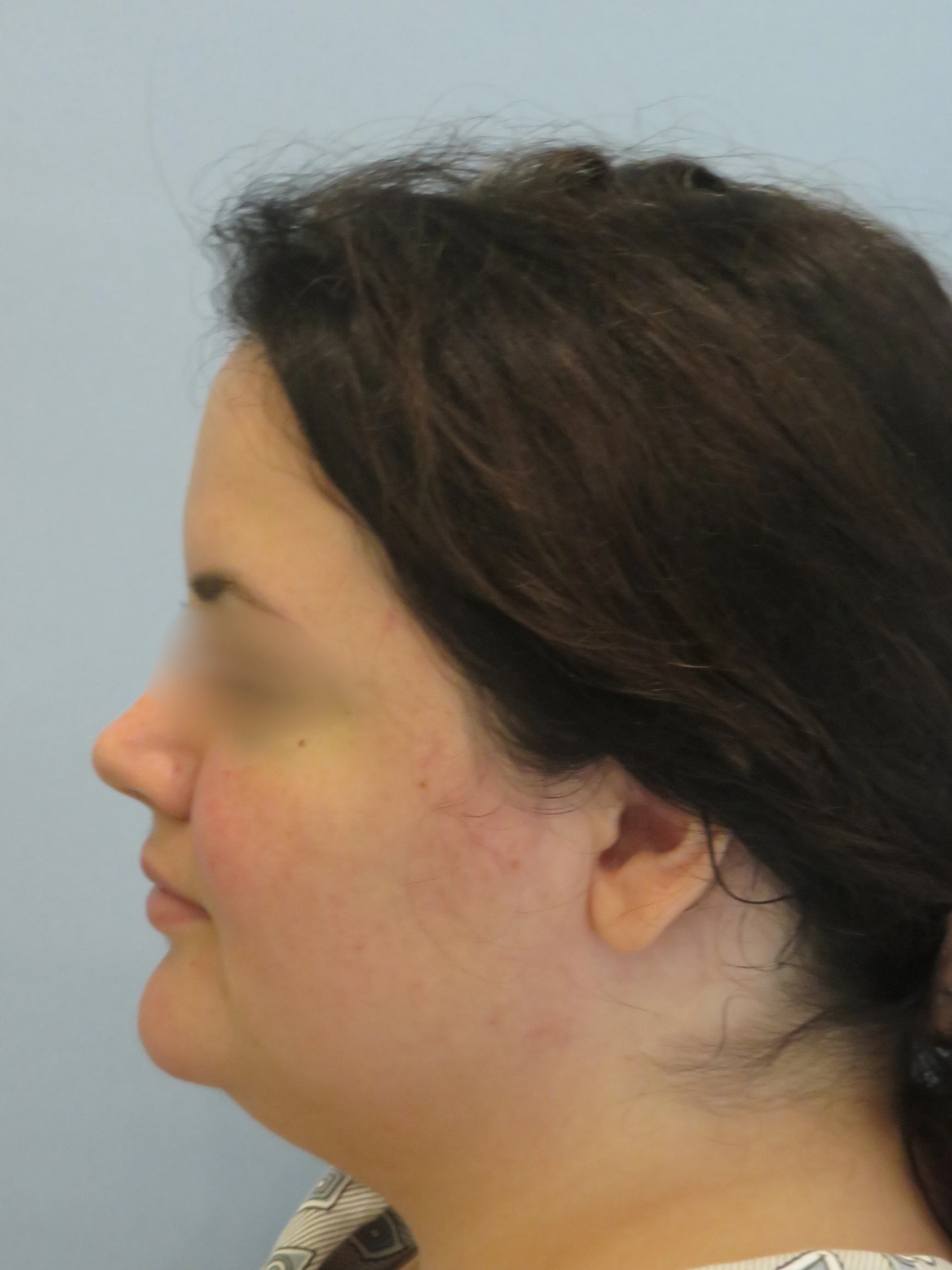 Before   Chin Lipo IMG 0744.JPG (1) — Aspira Plastic Surgery & Med Spa, Austin TX