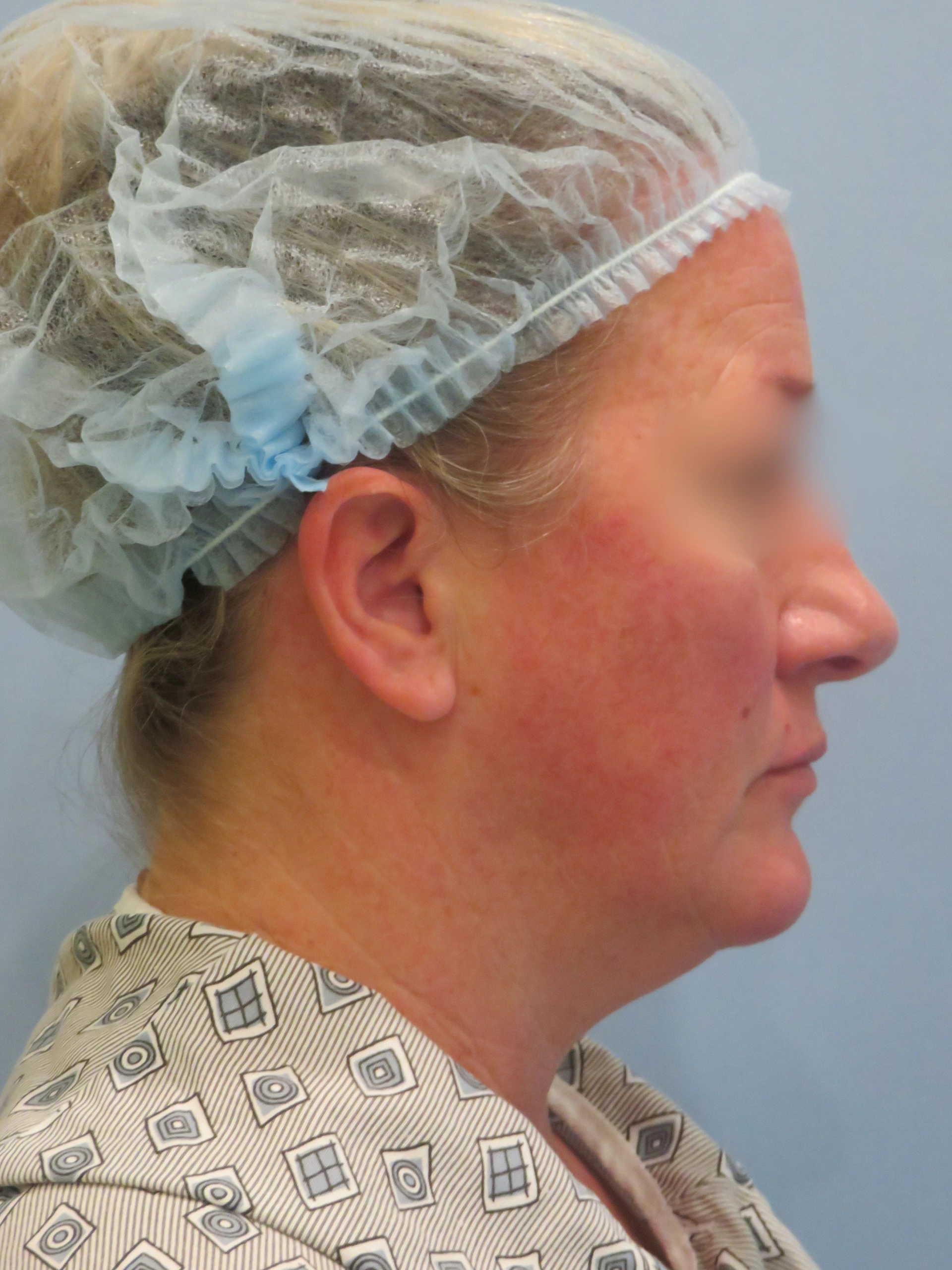 Before   Chin LIpo IMG 8259.JPG — Aspira Plastic Surgery & Med Spa, Austin TX