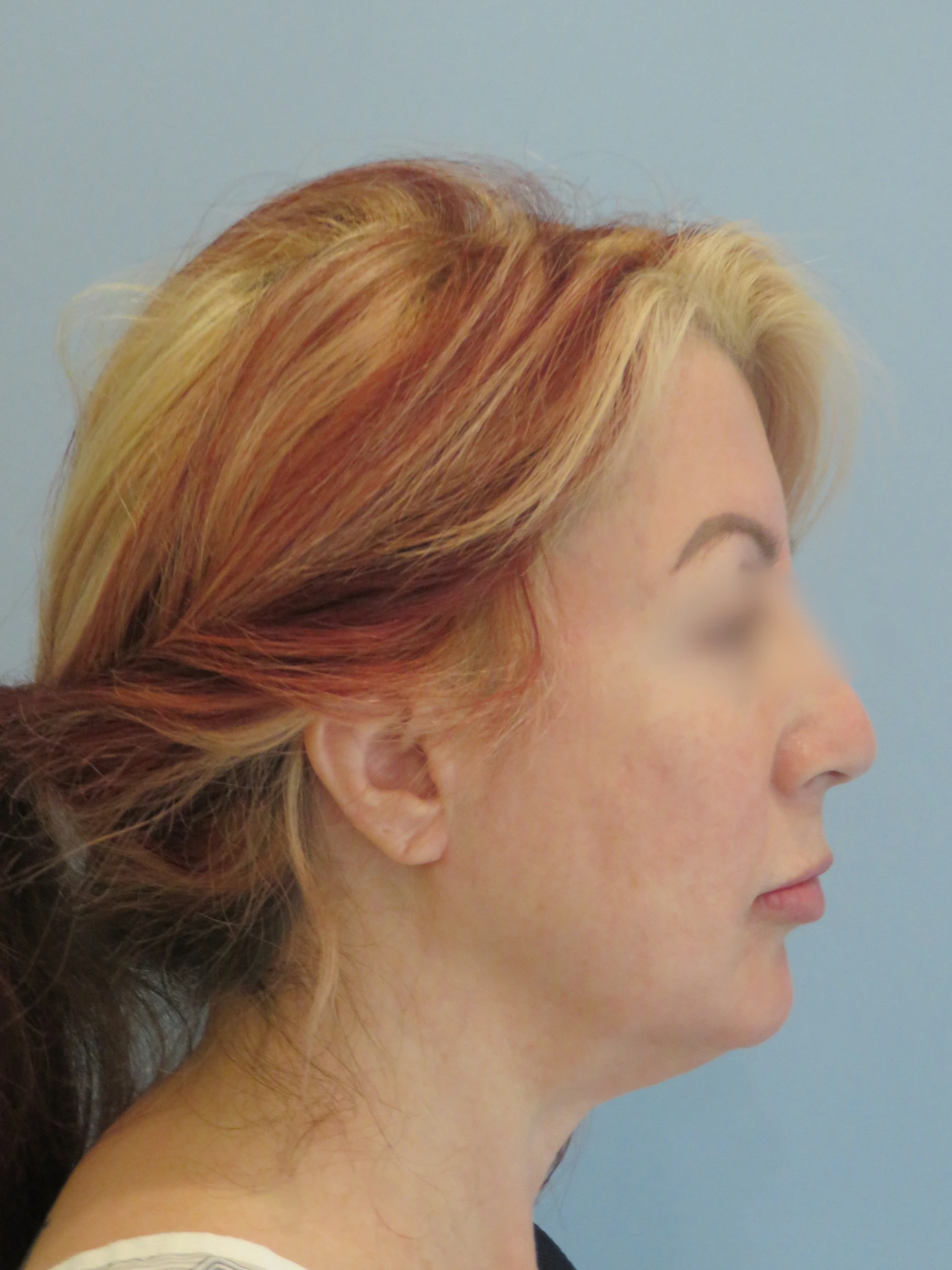 Before   Chin Lipo IMG 8978.JPG (1) — Aspira Plastic Surgery & Med Spa, Austin TX