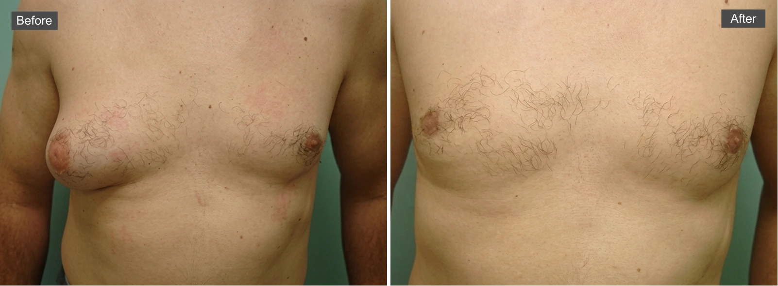 Before and after gynecomastia surgery: left shows enlarged breast tissue, right shows flattened chest contour