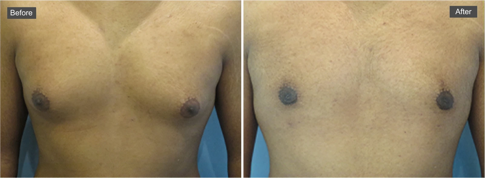 Before and after gynecomastia treatment showing male chest with reduced tissue and improved contour