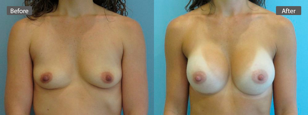 breast-aug-before-after1