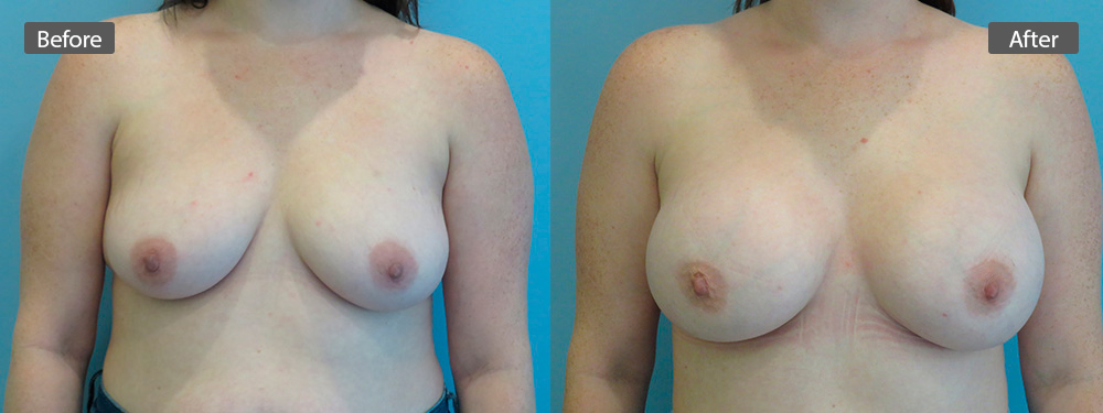 breast-aug-before-after2