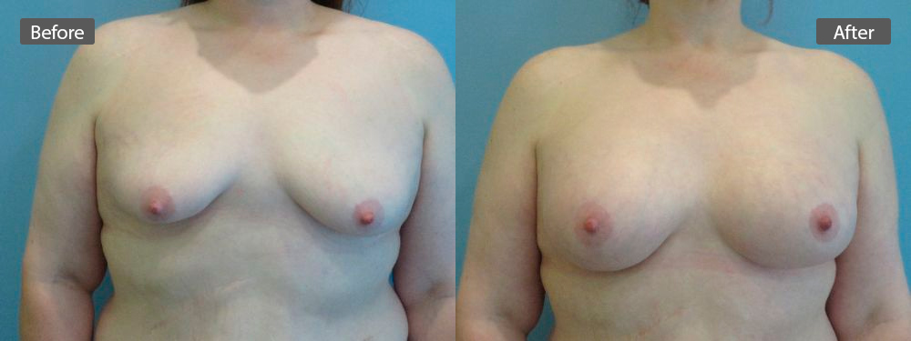 breast-aug-before-after3