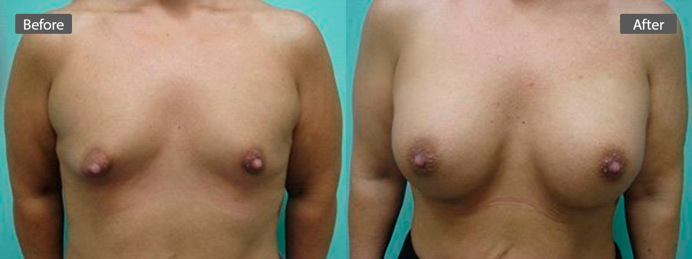 breast-aug-before-after4