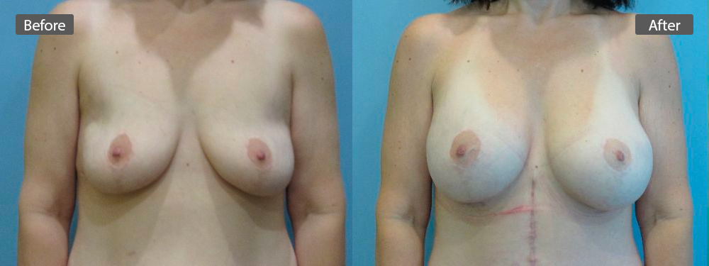breast-aug-before-after5
