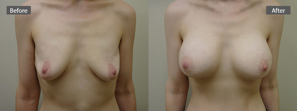 breast-aug-before-after6