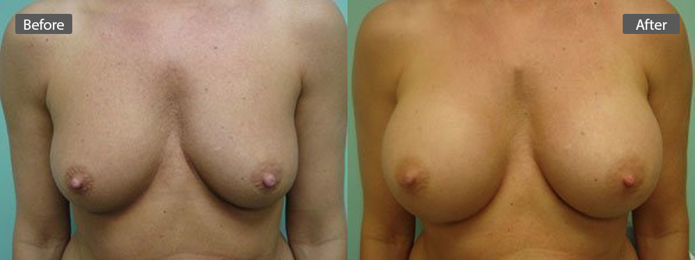 breast-aug-before-after7