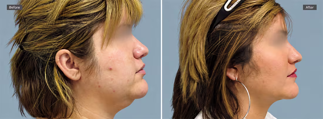 Awake Chin Liposuction Before & After Photos