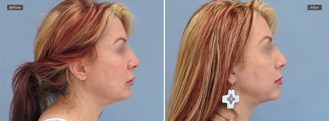 Awake Chin Liposuction Before & After Photos