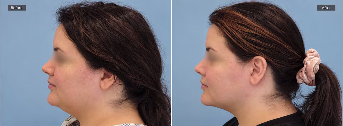 Awake Chin Liposuction Before & After Photos